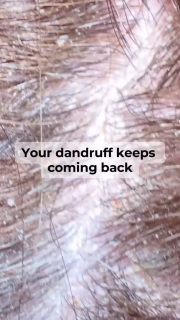 Dandruff + itchy scalp combo is the WORST 😭
This Caditar Antiseborrheic & Anti-Dandruff Shampoo actually made the scalp feel clean without drying my hair.
#dandruff #scalpcare #seborrheicscalp #itchscalp #haircare